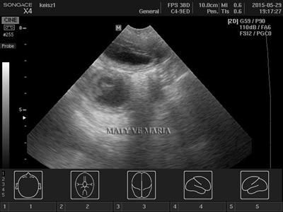 Sonographic examination - the 29th day of pregnancy