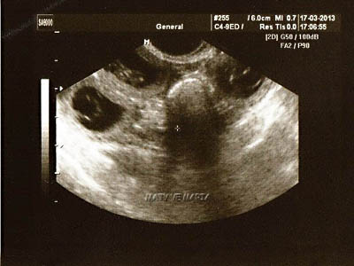Sonographic examination - the 27th day of pregnancy