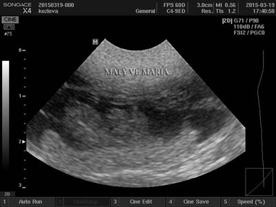 Sonographic examination - the 33rd day of pregnancy